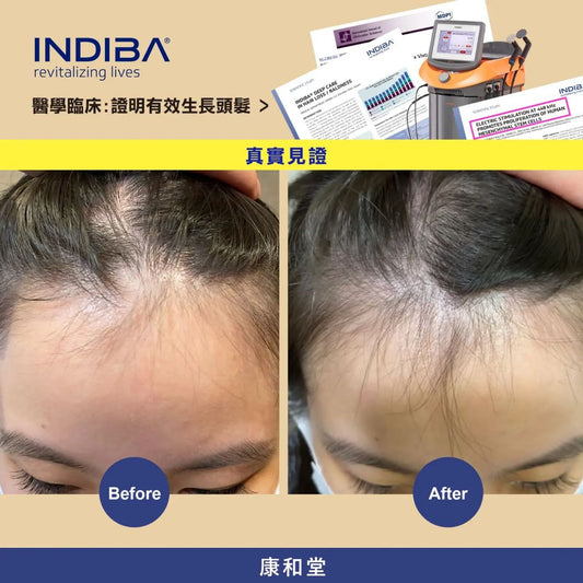 ✨康和堂 x INDIBA爆髮療程 超過150篇📄醫學臨床論文,證明有效生長頭髮 ✨️首次只需$380