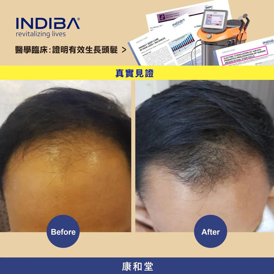 ✨康和堂 x INDIBA爆髮療程 超過150篇📄醫學臨床論文,證明有效生長頭髮 ✨️首次只需$380
